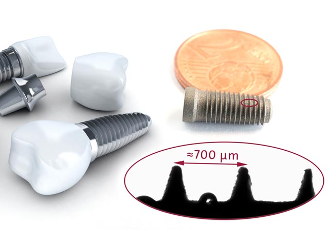 Nanolitre drop between the screw threads of a dental implant